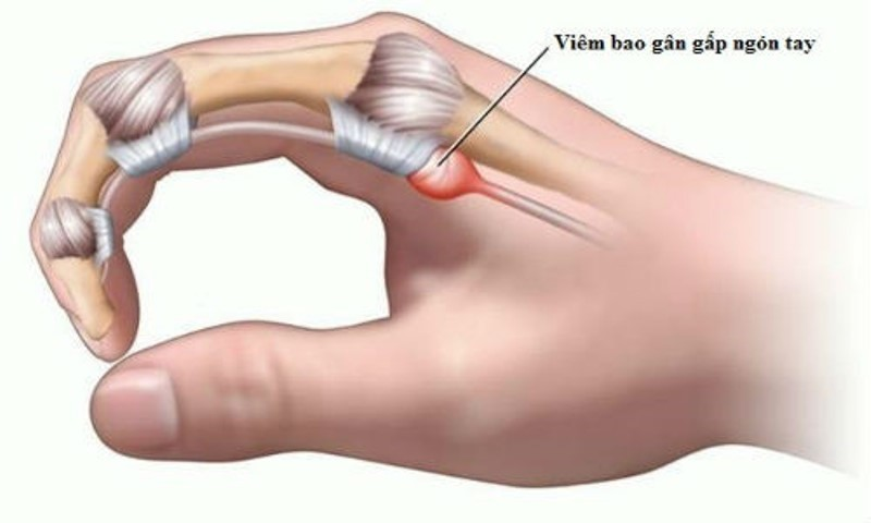 viêm bao gân gấp ngón tay lò xo