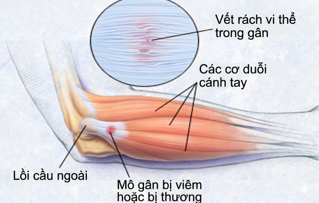 Tennis elbow là gì