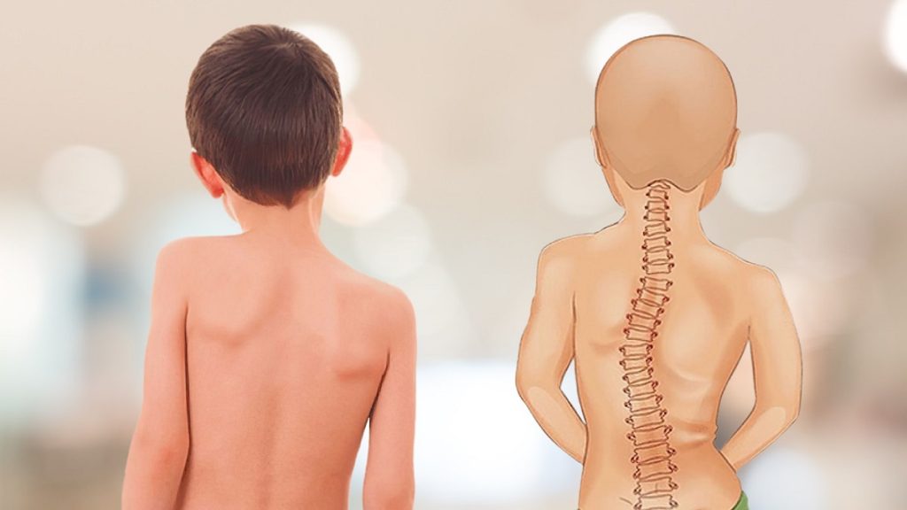 Vẹo cột sống ở trẻ em