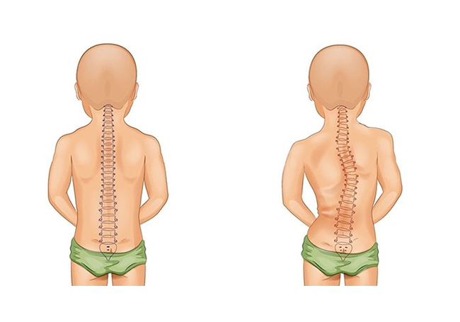 Vẹo cột sống ở trẻ em